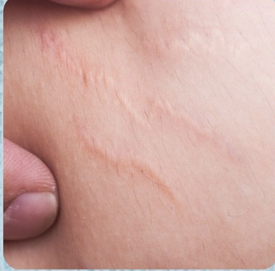 Tratamiento de Estrías